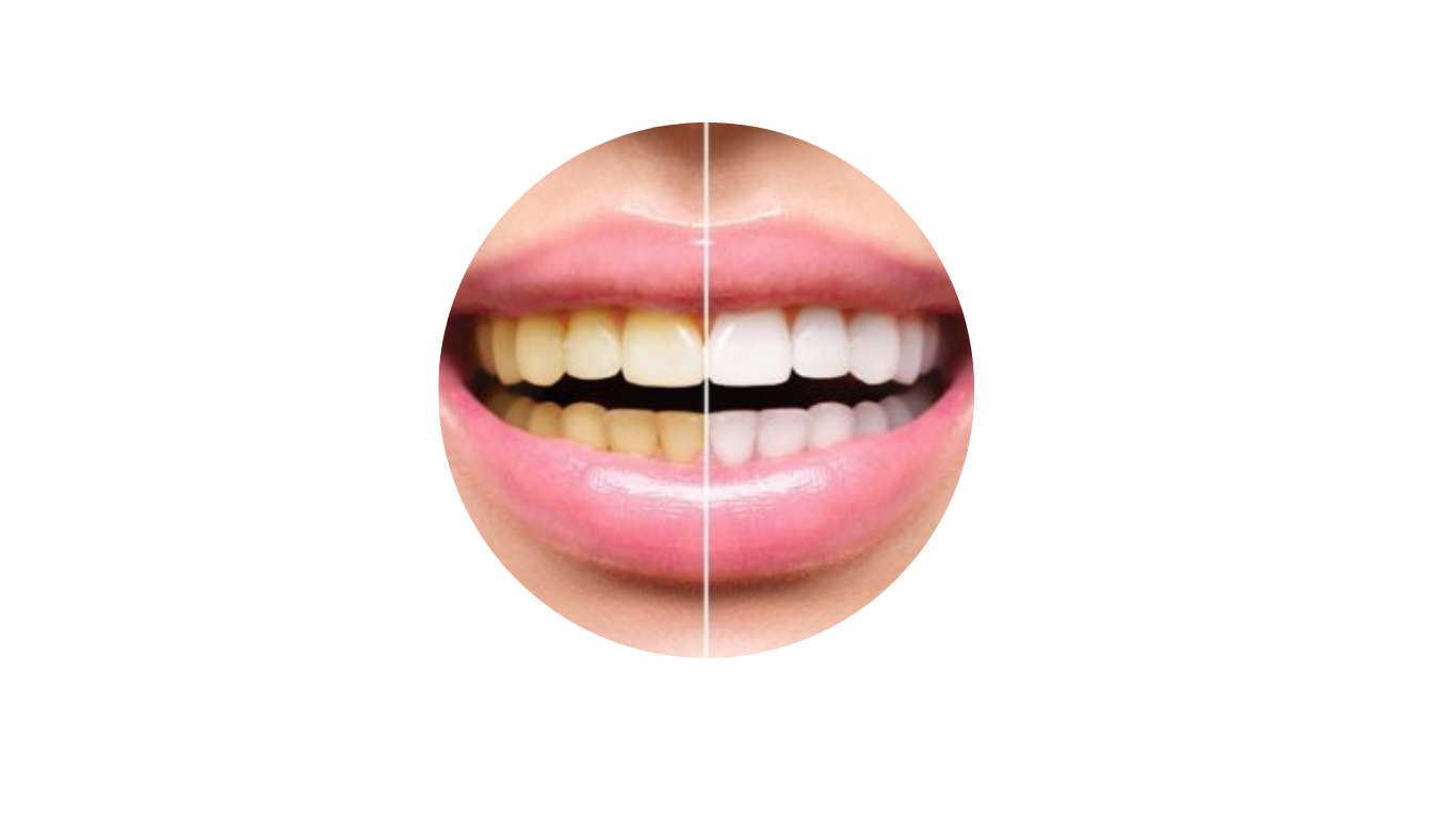 Teeth Whitening